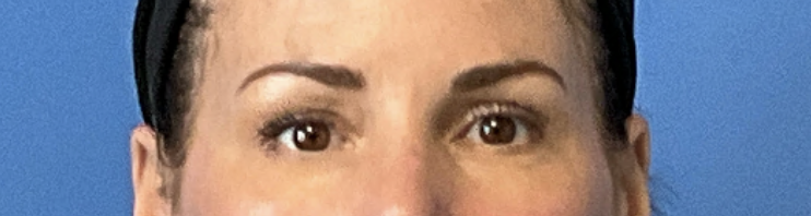 Blepharoplasty--Case-Study-3078 | Before Blepharoplasty